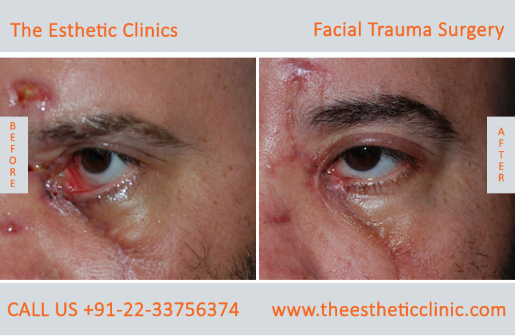 Facial Trauma surgery, Maxillofacial Reconstruction Surgery before after photos in mumbai india (6)